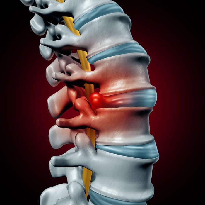 ERNIA DEL DISCO E TRATTAMENTO OSTEOPATICO
